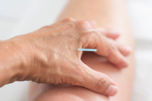 Acupuncture needle is in the hand of a woman Acupuncture needle is in the hand of a woman